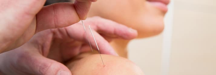 performing acupuncture on woman's shoulder